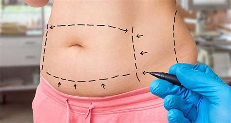 tijuana tummy tuck cost|Tummy Tuck